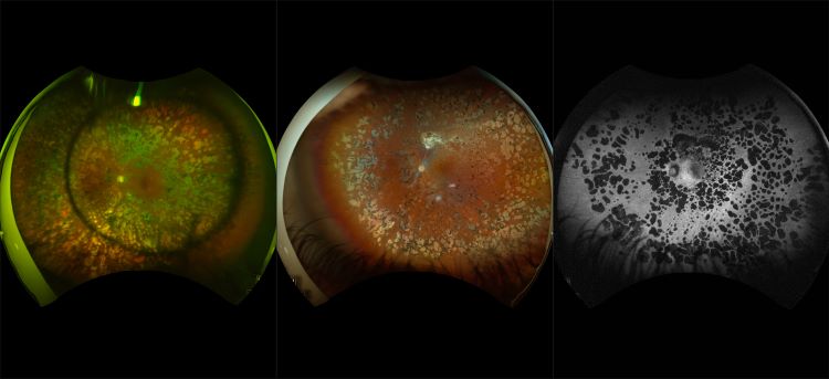 California - Treated Diabetic Retinopathy, RG, RGB, AF