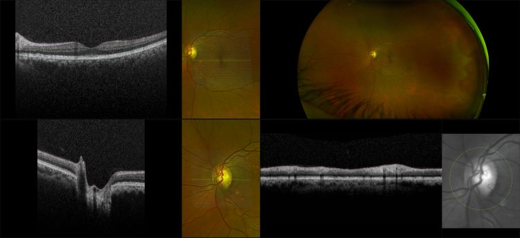 Monaco - Glaucoma, RG, OCT