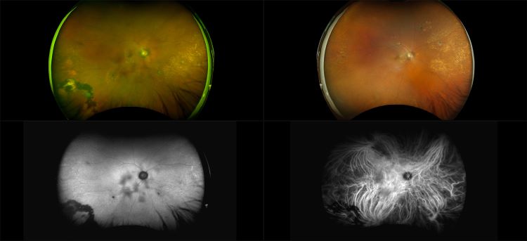 California - Exudative AMD, RG, RGB, AF, ICG