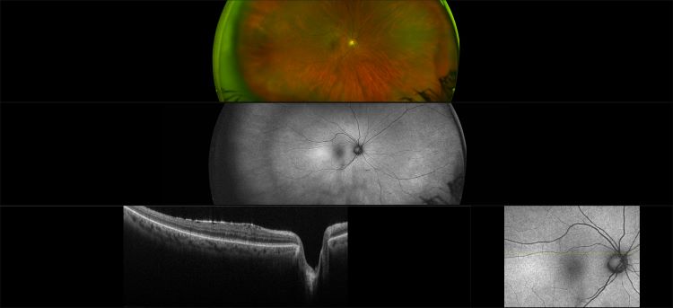 Monaco - Epiretinal Membrane, RG, AF, OCT