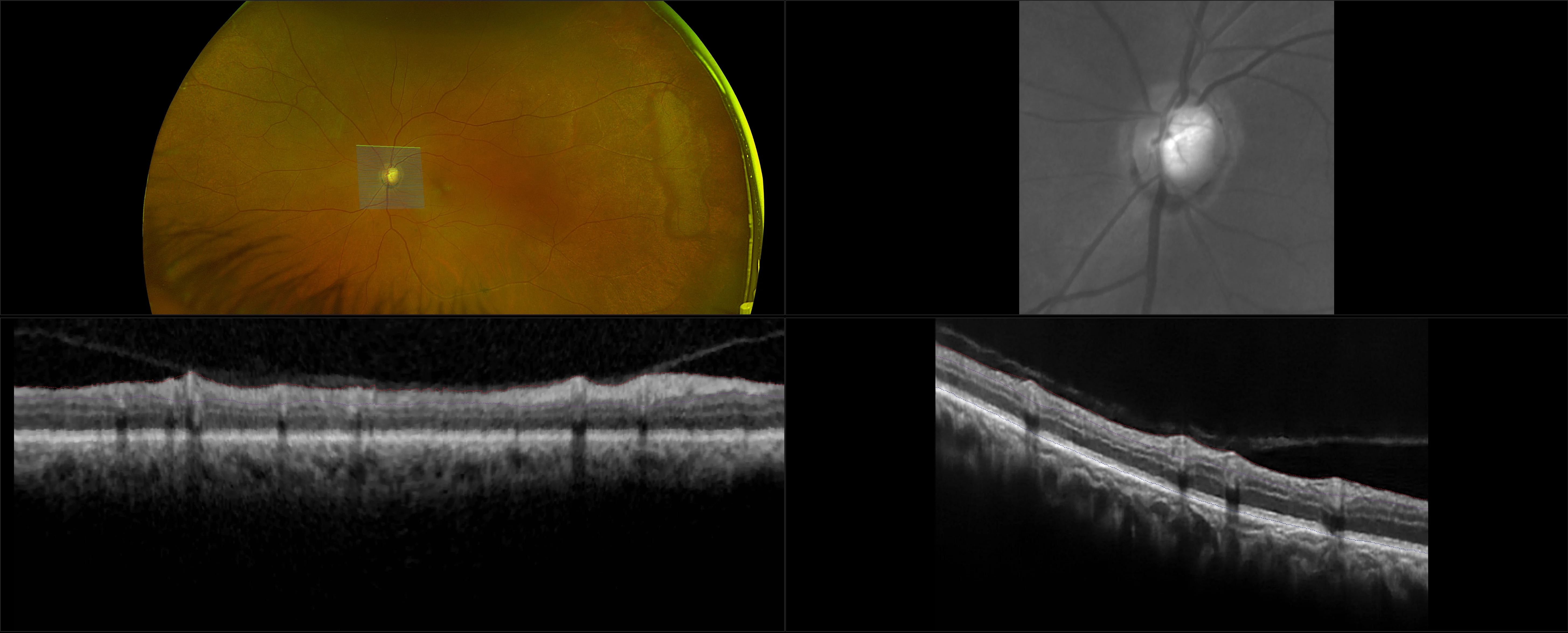 MonacoPro - Deep Cup Glaucoma - RG, OCT