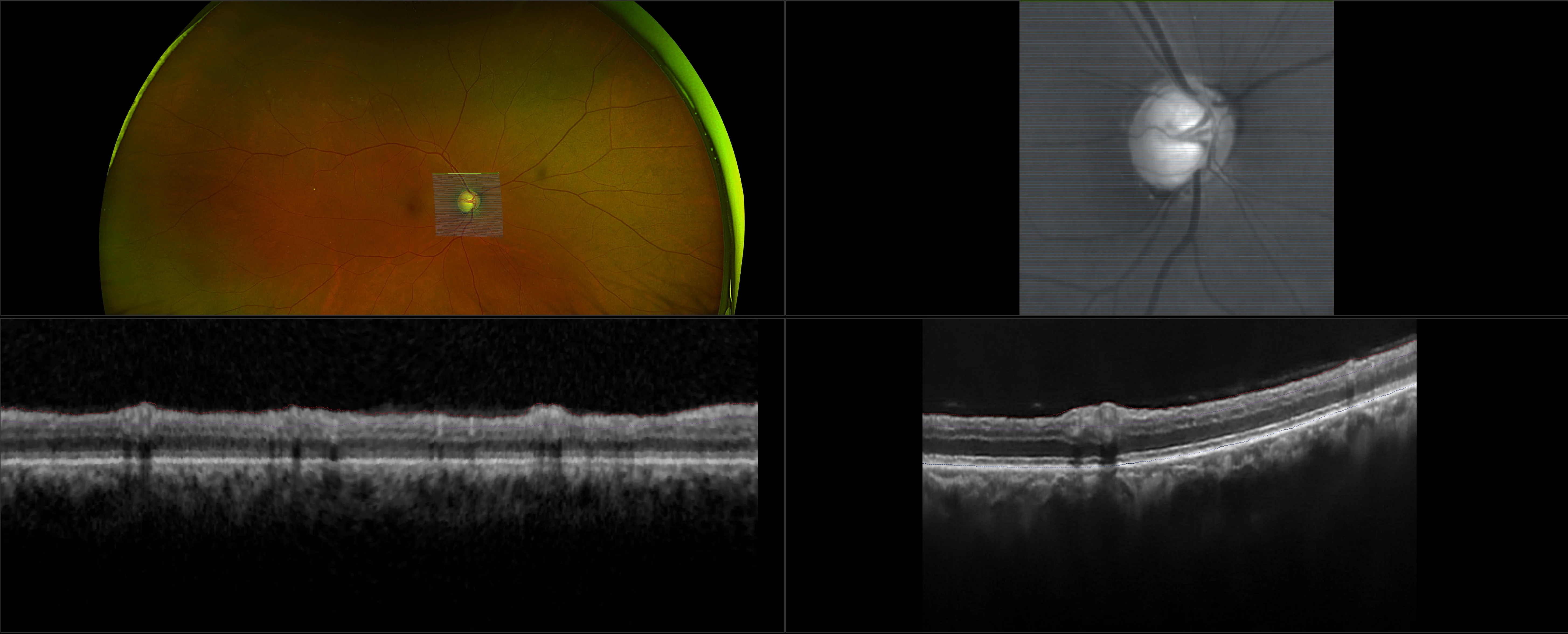 MonacoPro - Advanced Glaucoma - RG, OCT