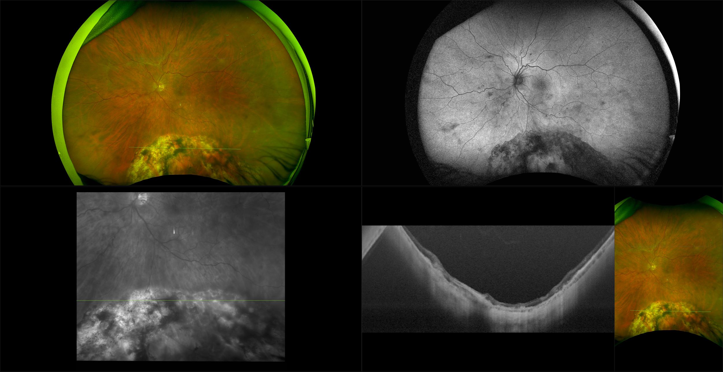 Silverstone - Repaired Horseshoe Tear, RG, AF, OCT