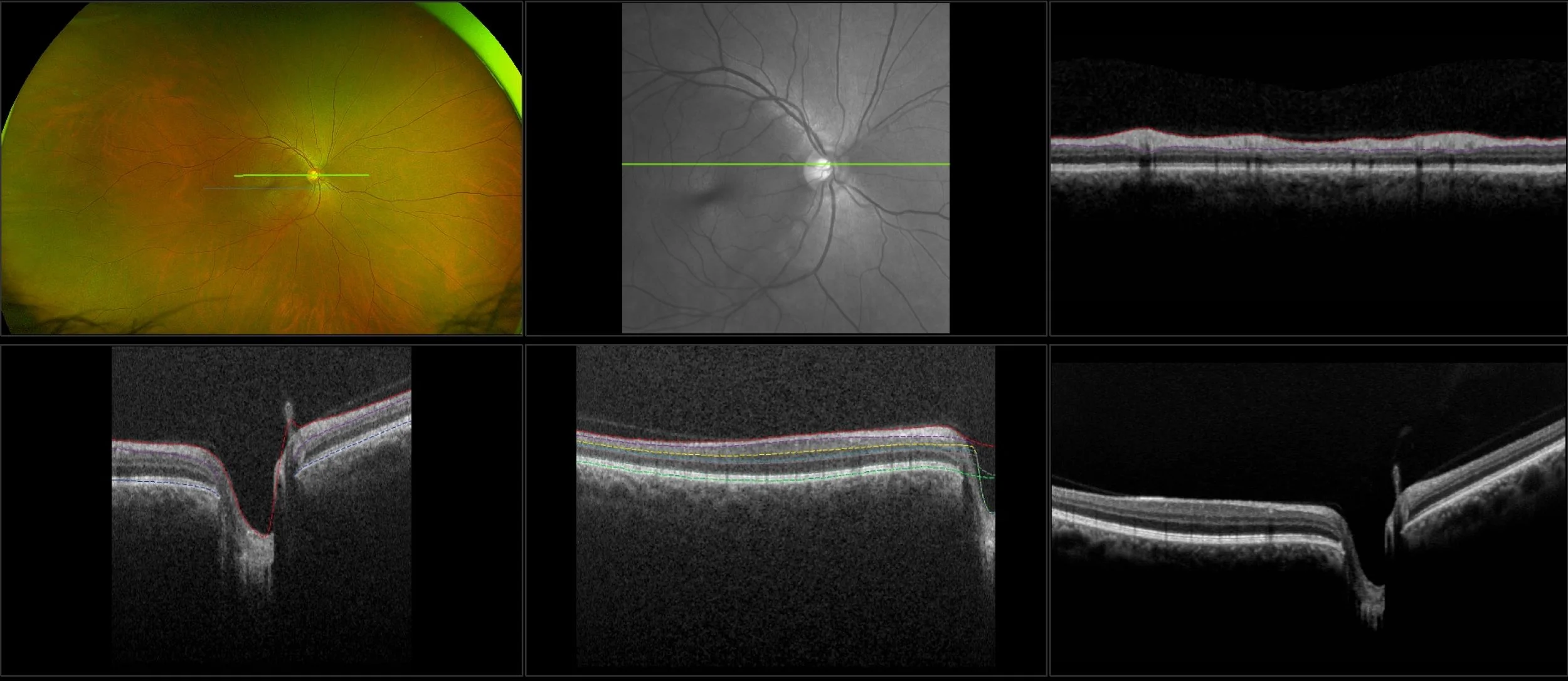 Monaco - Glaucoma, RG, Stereo, OCT