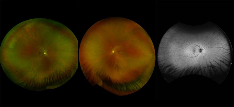 California - Central Serous Chorioretinopathy, RG, RGB, AF