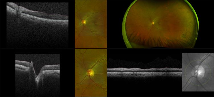 Monaco - Pigment Epithelial Detachment with Peripheral Degeneration, RG, OCT