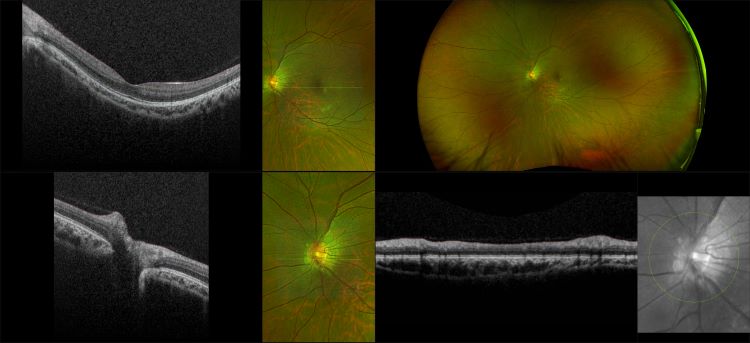 Monaco - Myopia, RG, OCT