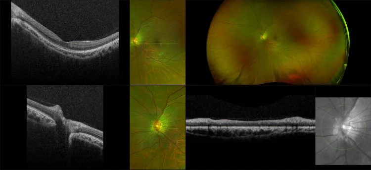 Monaco - Myopia, RG, OCT