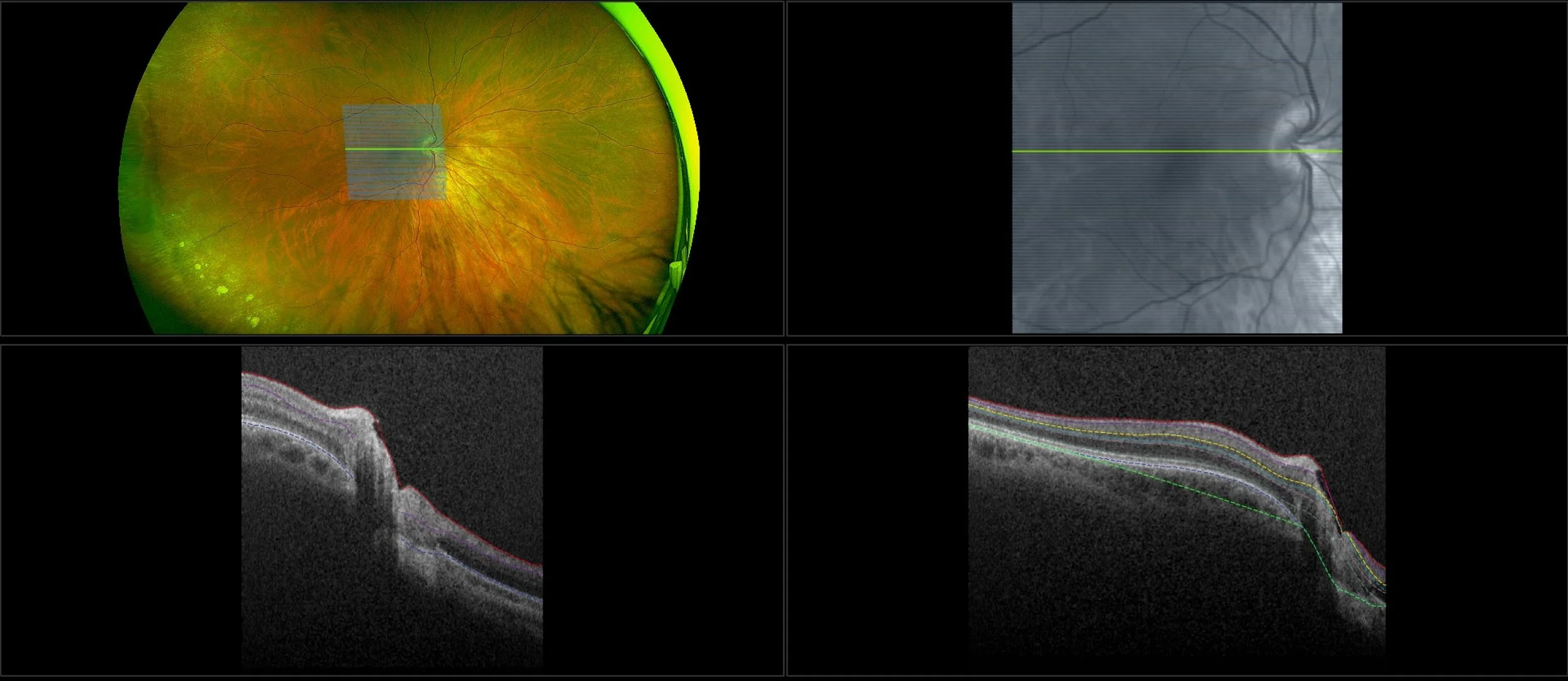 Monaco - Glaucoma, RG, Stereo, OCT