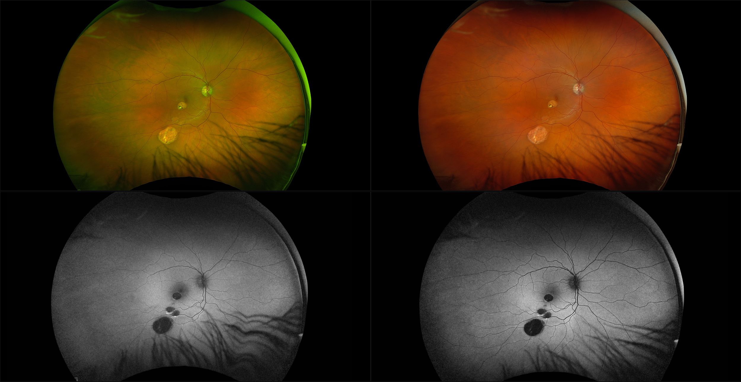 California - Chorioretinal Scarring, RG, RGB, AF, BAF