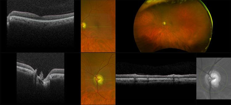 Monaco - Glaucoma, RG, OCT