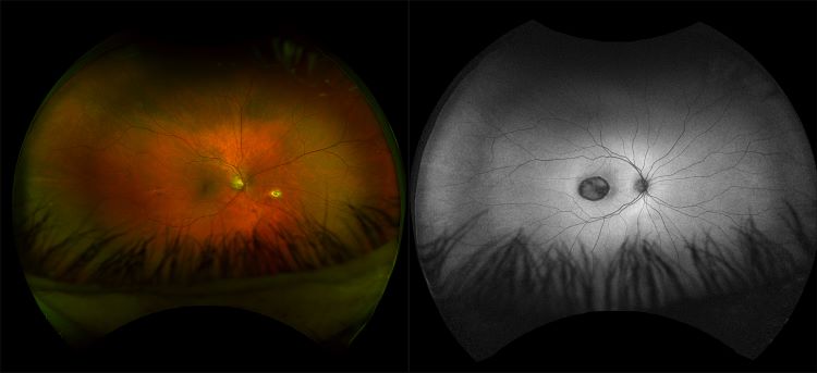 Daytona - Toxoplasmosis, RG, AF