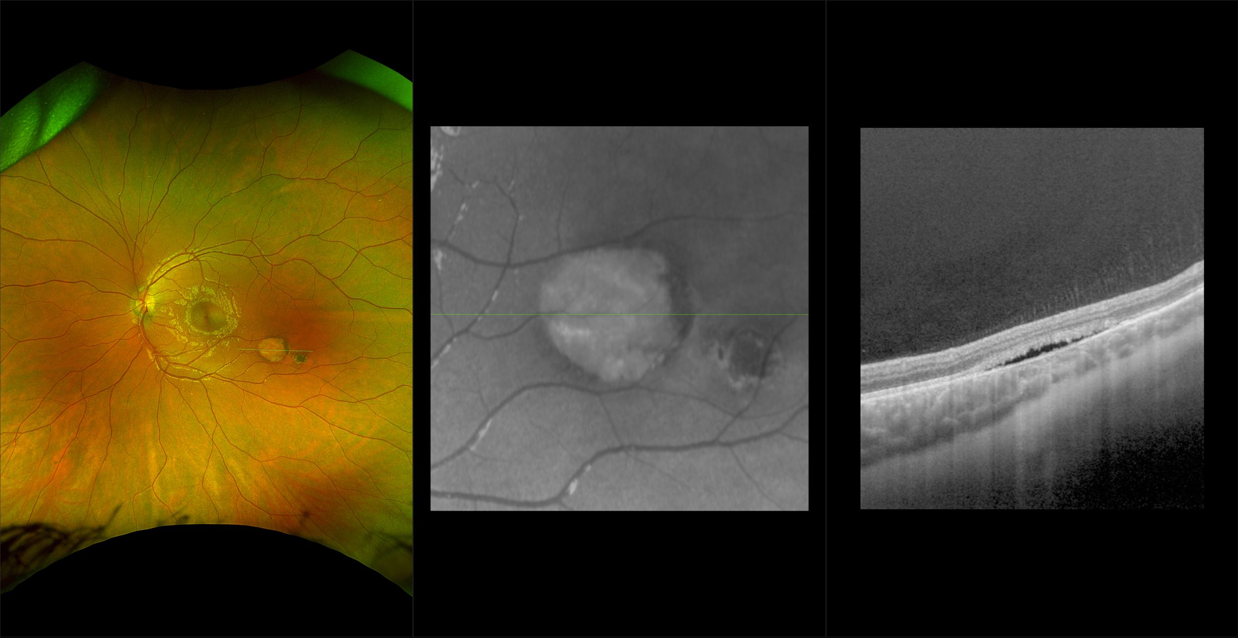 Silverstone - Congenital Hypertrophy of the RPE, RG