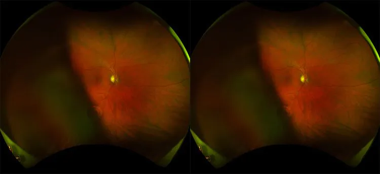 Daytona - Healthy Retina - Stereo - RG