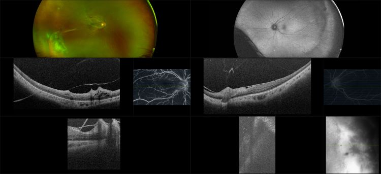 Silverstone - Sickle Cell Disease, RG, AF, FA, OCT 