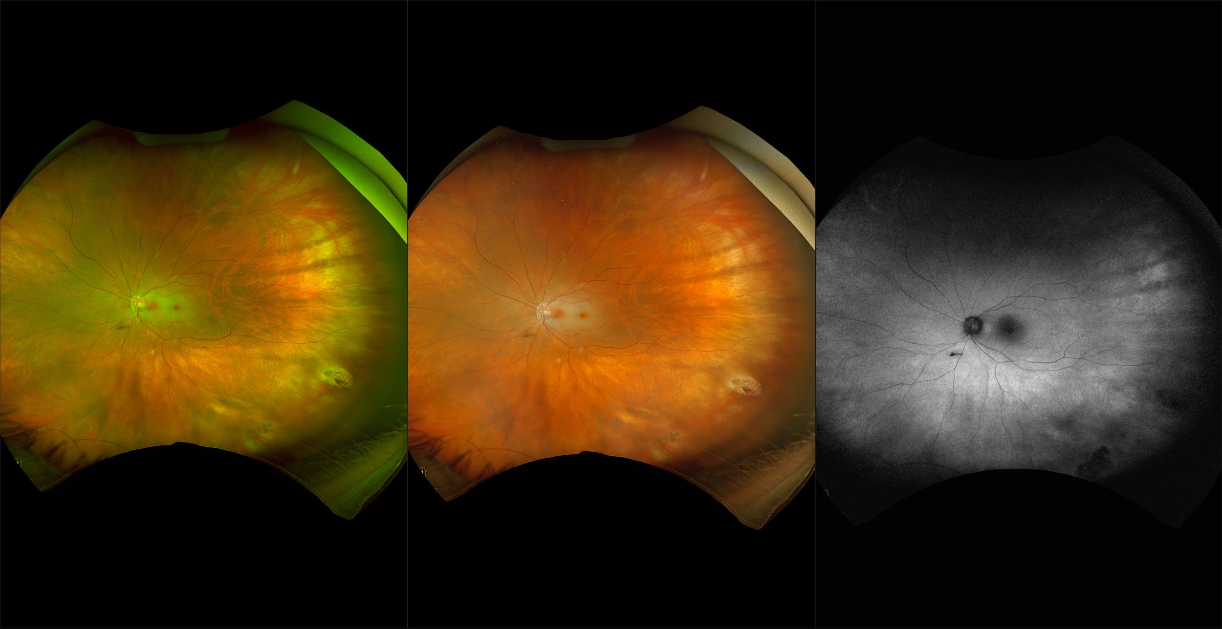 California - Acute Central Retinal Artery Occlusion, RG, RGB, BAF