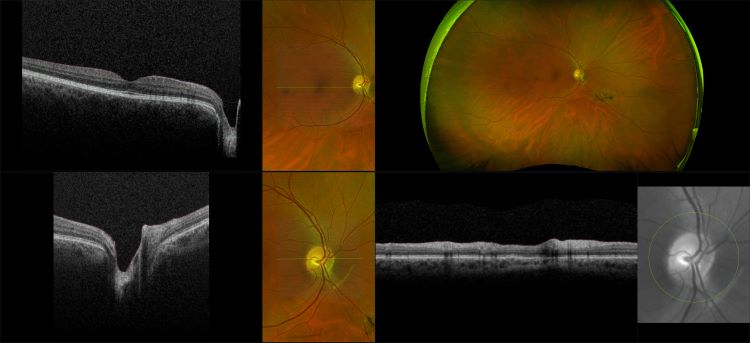 Monaco - Peripheral Lesion, RG, OCT