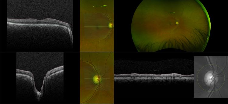 Monaco - Glaucoma with Wedge Defect, RG, OCT