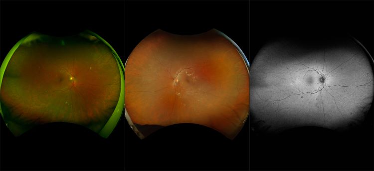 California - Proliferative Diabetic Retinopathy, RG, RGB, AF, FA