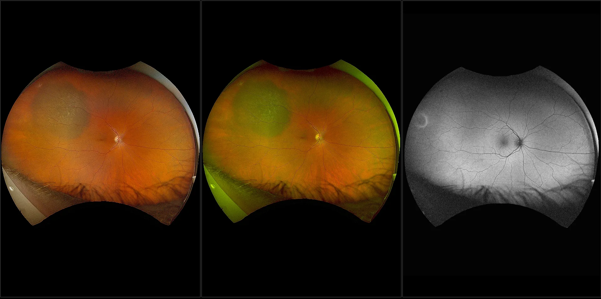 California - Choroidal Nevus, RG, RGB, AF