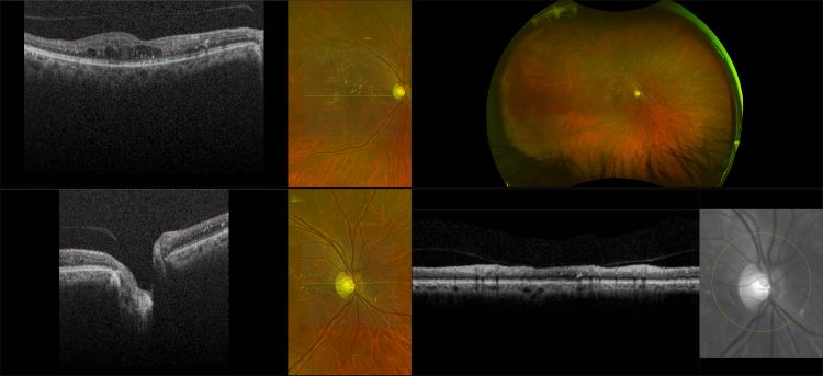 Monaco - Diabetic Retinopathy with DME, RG, OCT