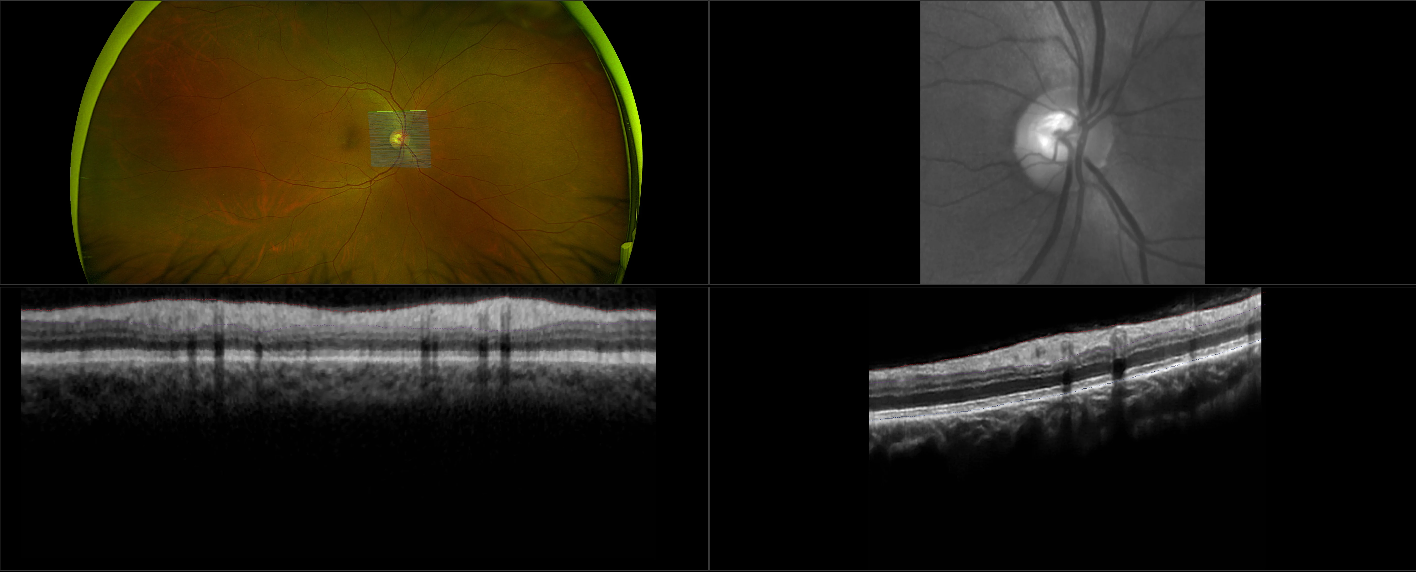 MonacoPro - Macular Pucker - RG, OCT