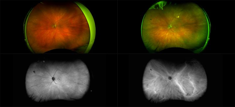 California - Macular Neovascularization, RG, RGB, AF, ICG