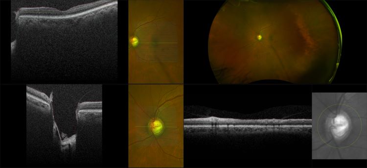 Monaco - Deep Cup Glaucoma, RG, OCT