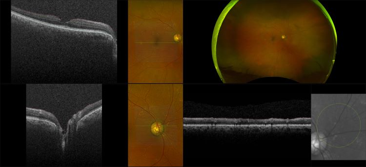 Monaco - Wet AMD with Macular Drusen and Sub-Retinal Fluid, RG, OCT