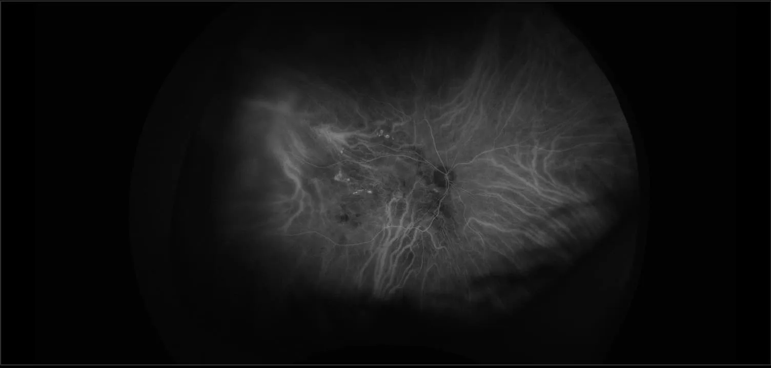 California - Polypoidal Choroidal Vasculopathy, ICG