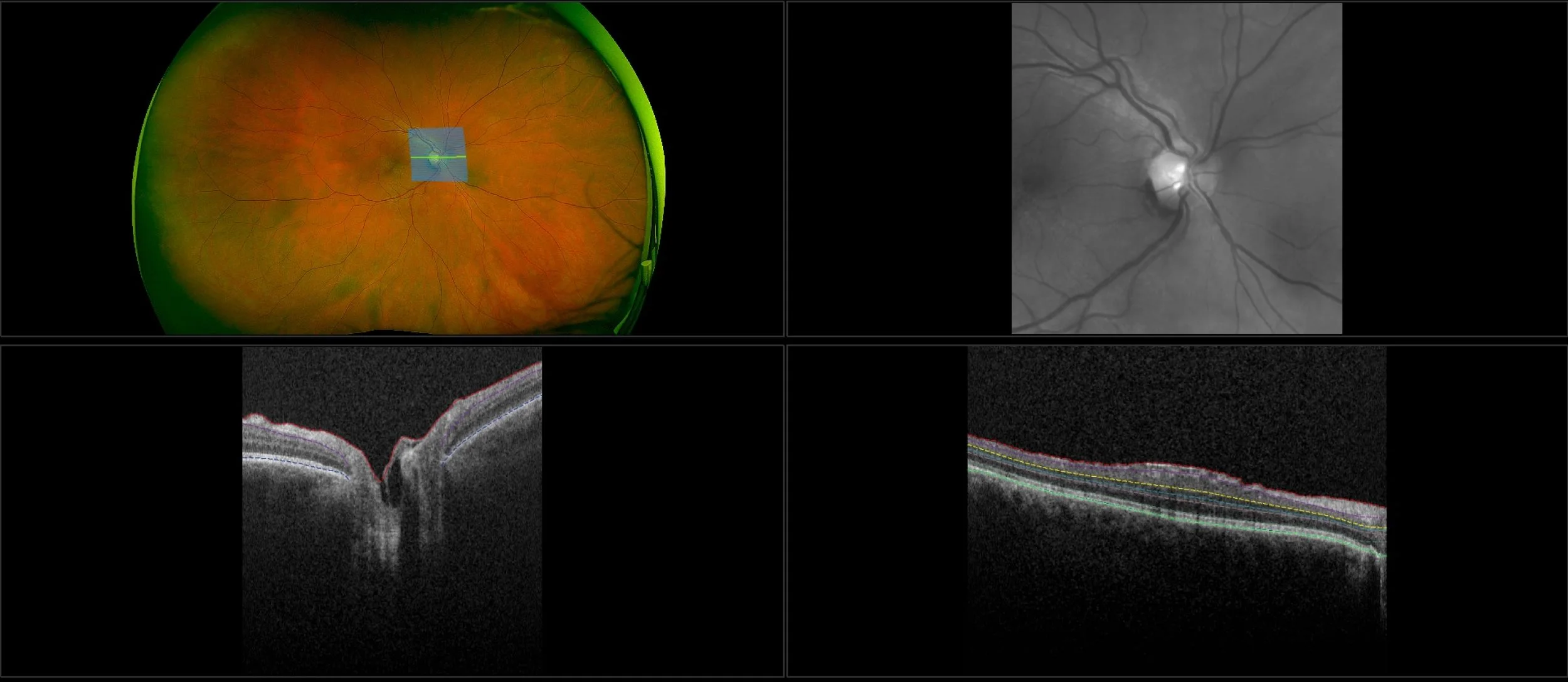 Monaco - Macular Pucker, RG, OCT