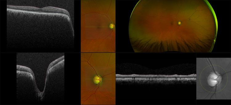 Monaco - Advanced  Glaucoma, RG, OCT