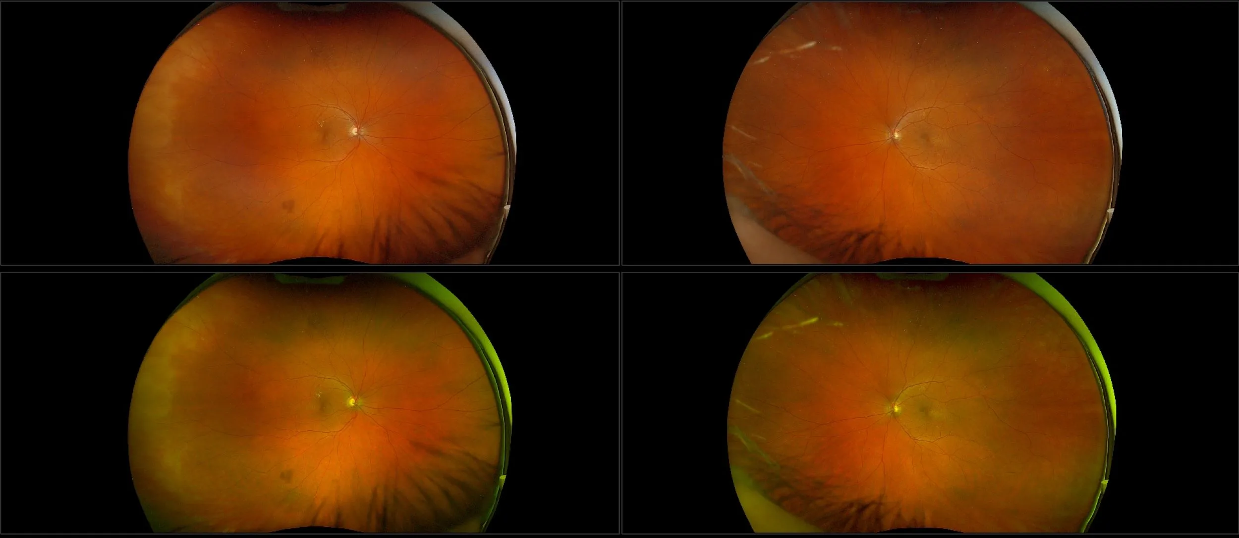 California - Nonproliferative Diabetic Retinopathy with Lipid, RG, RGB