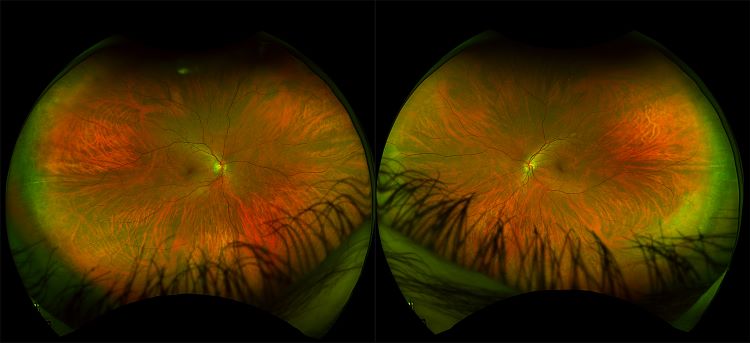 Daytona - Healthy Retina, RG, AF