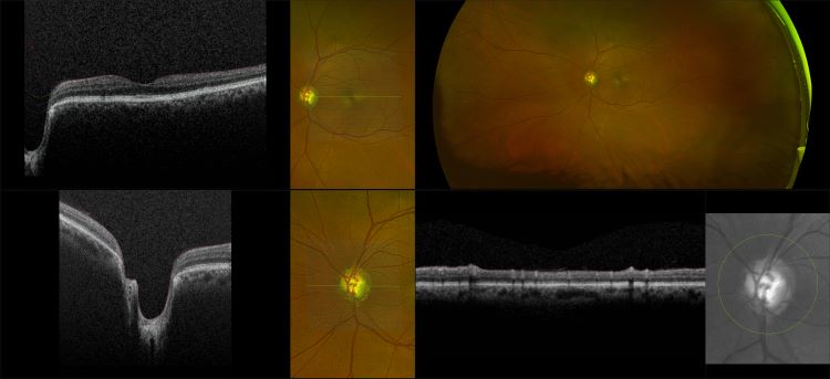 Monaco - Glaucoma, RG, OCT