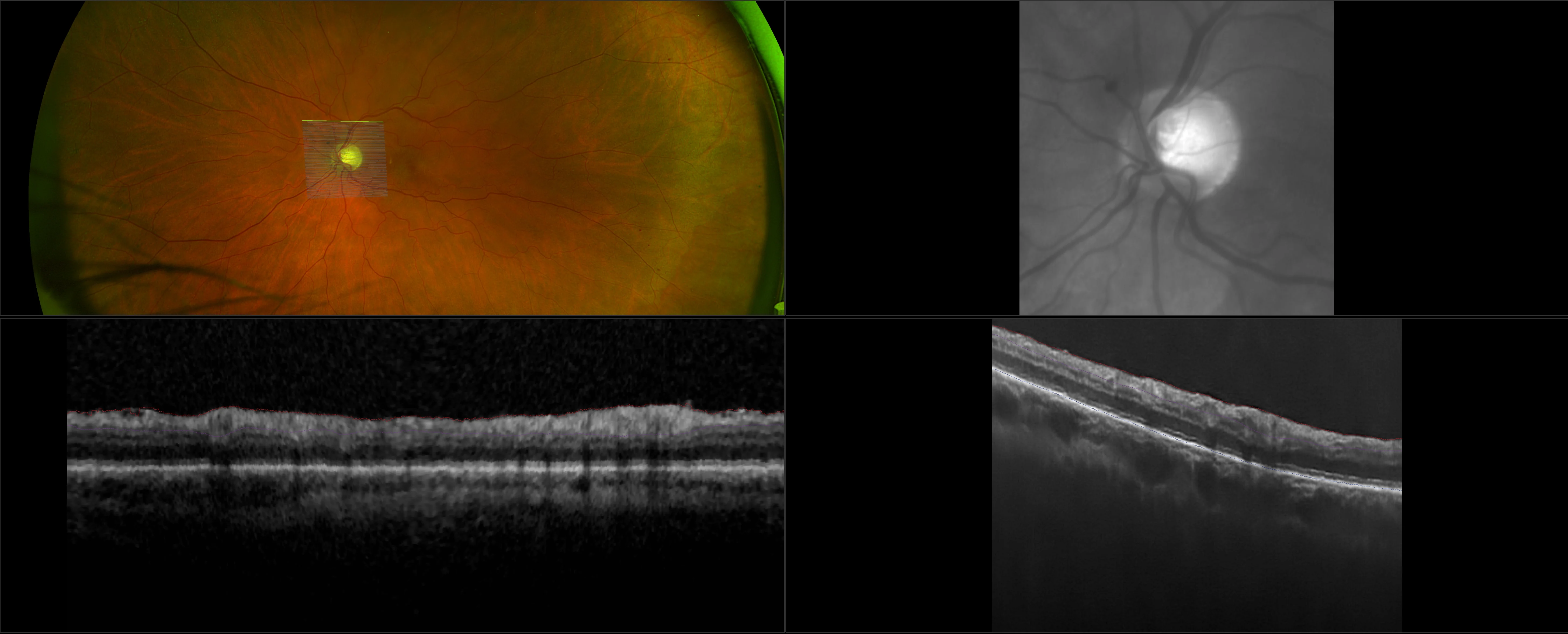 MonacoPro - Macular Pucker - RG, OCT