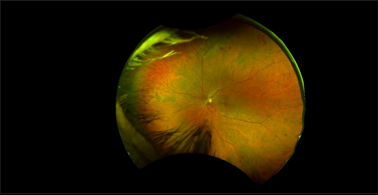 California - Hyperviscosity Retinopathy from Myeloma, RG