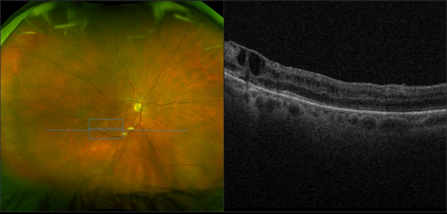 Silverstone - Macular Hole, RG, OCT