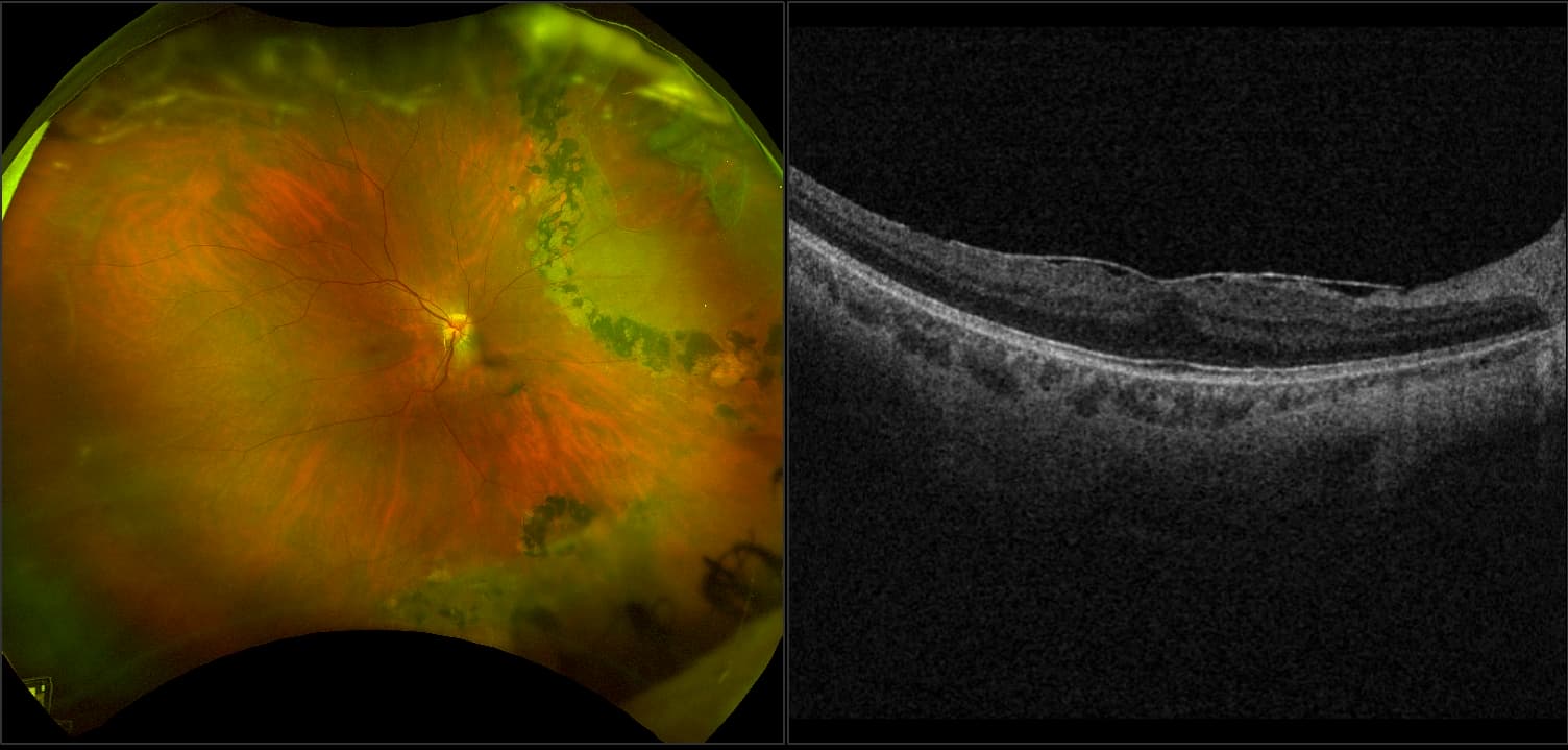 Silverstone - Epiretinal Membrane with Retinal Detachment, RG, OCT