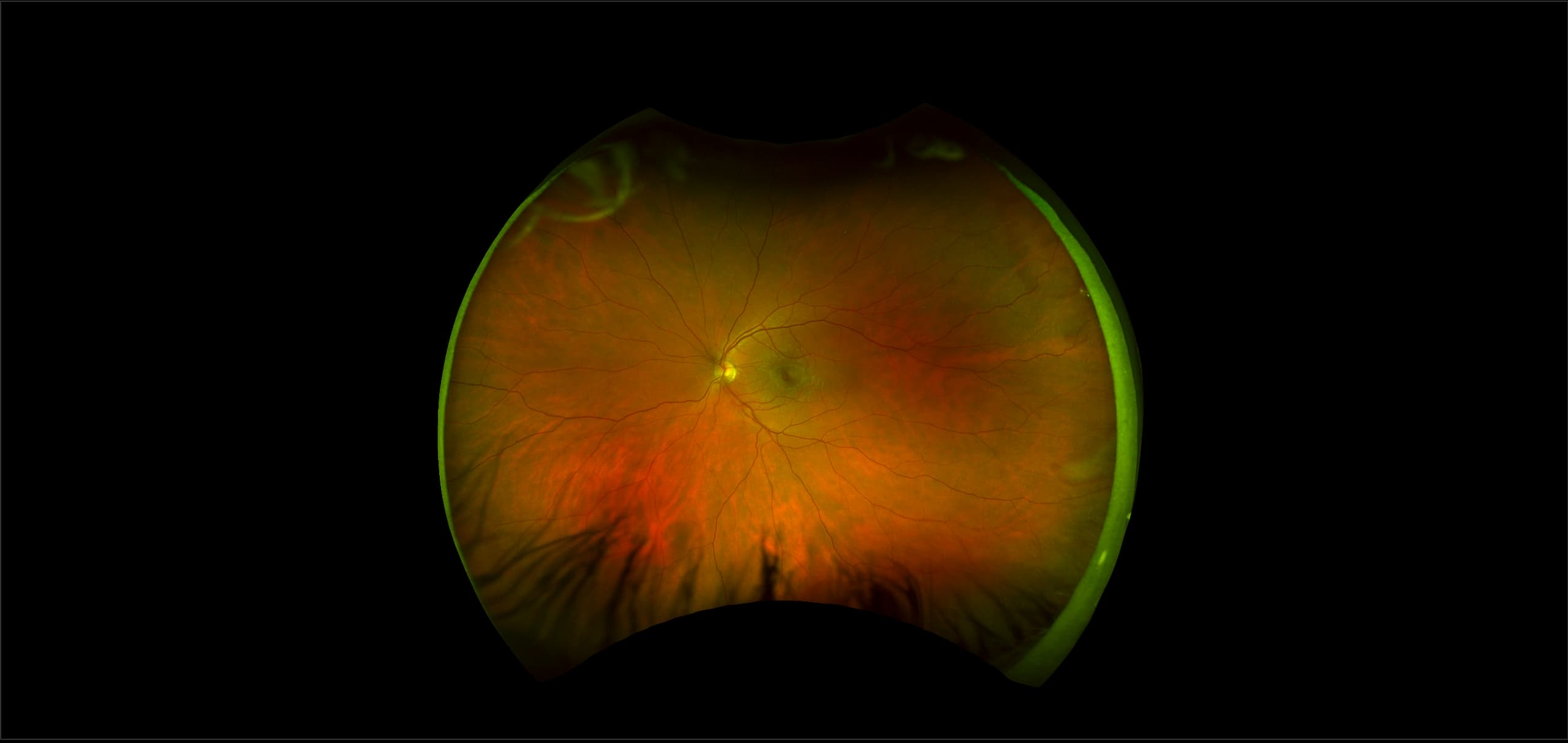 Monaco - Macular Pseudohole, RG