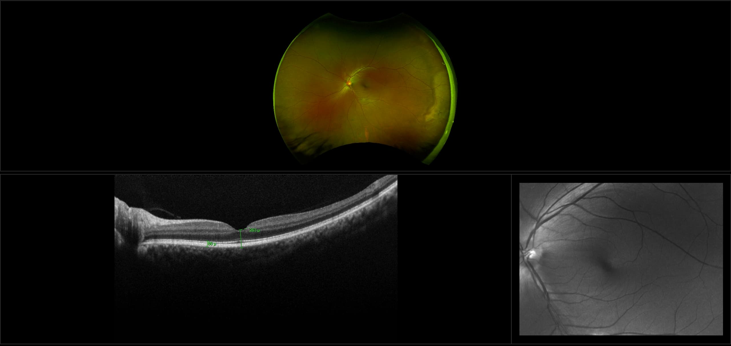 Monaco - Lattice Degeneration with White Without Pressure, RG, OCT