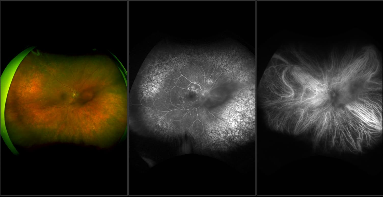 California - AMD with Peripheral Drusen and Cataract Artifact, RG, FA, ICG