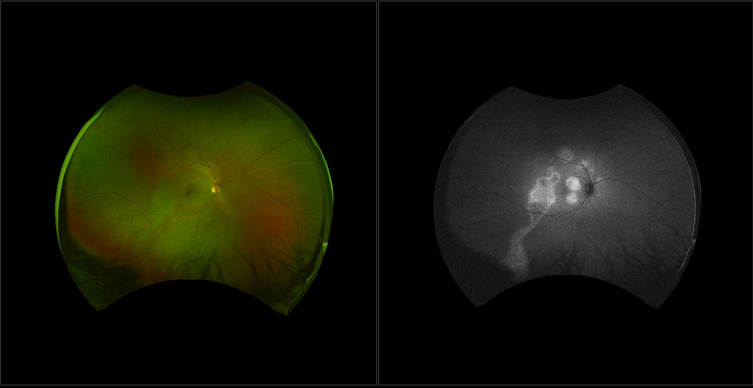 California - Central Serous Chorioretinopathy, RG, AF