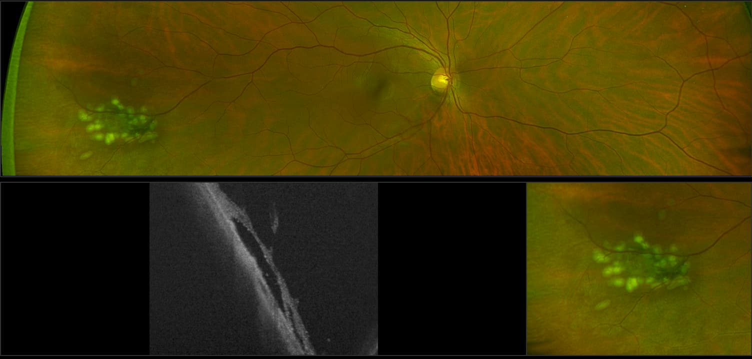 Silverstone - Far Peripheral Tear, RG, OCT