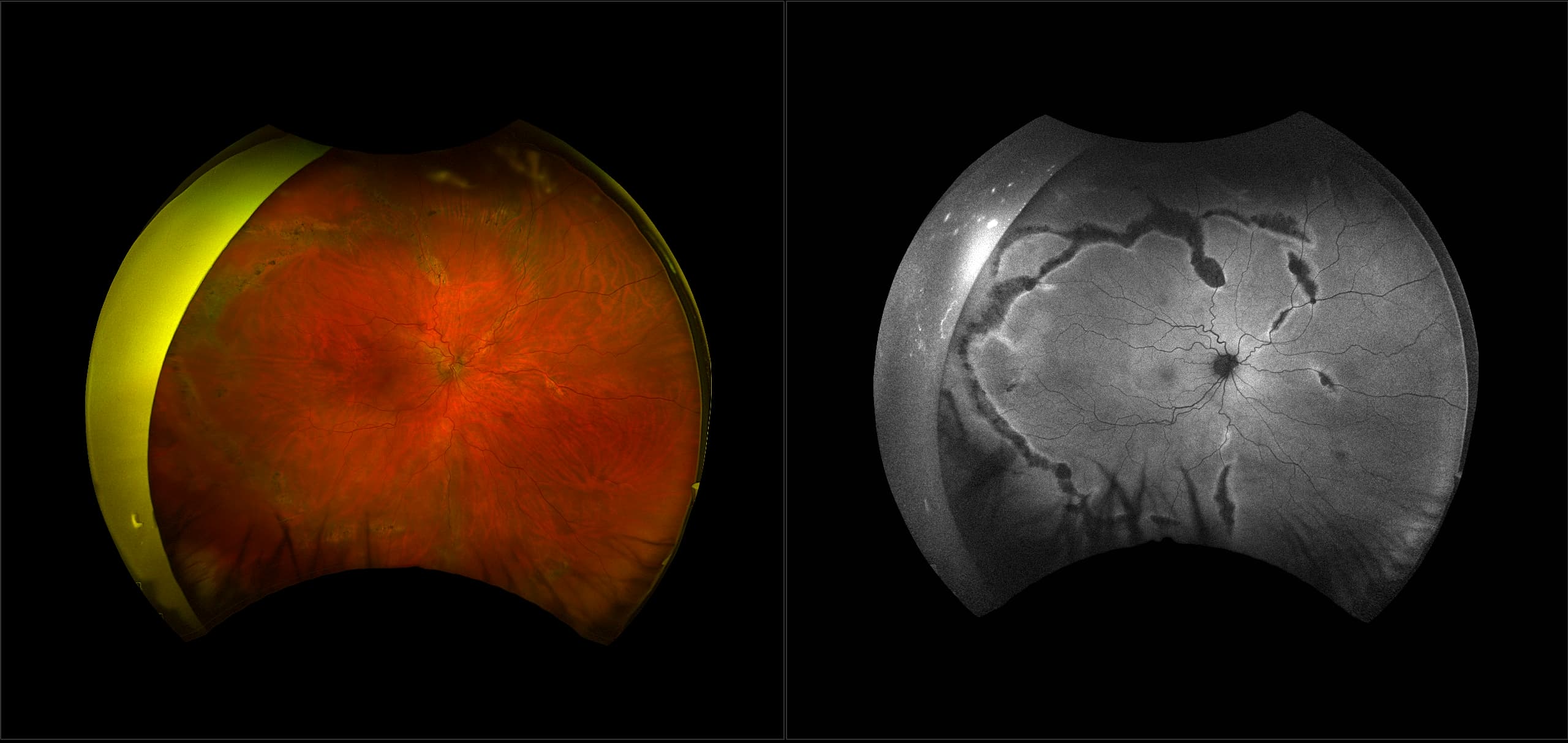 California - Stickler Syndrome, RG, AF