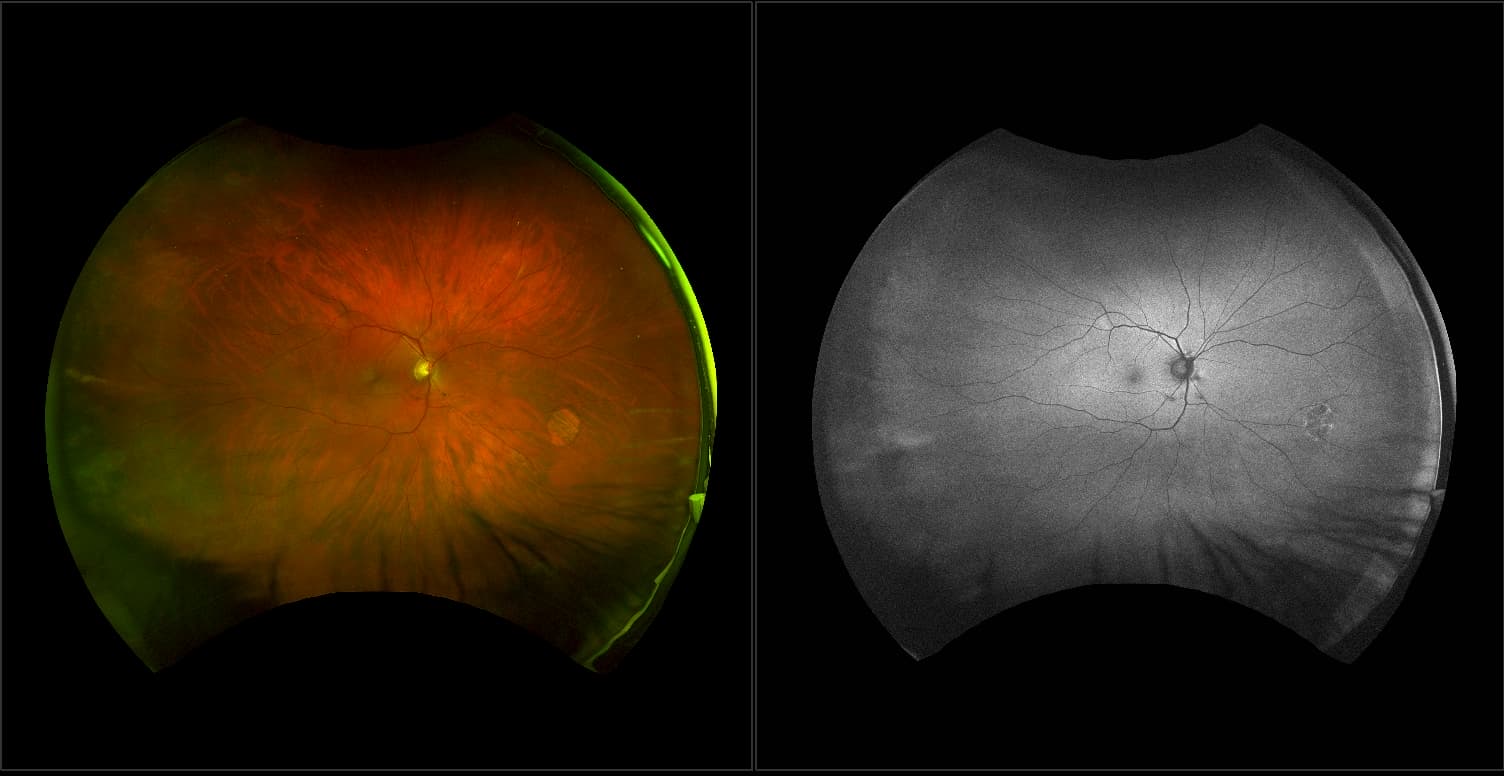 California - Glaucoma Suspect - Stereo, RG, AF