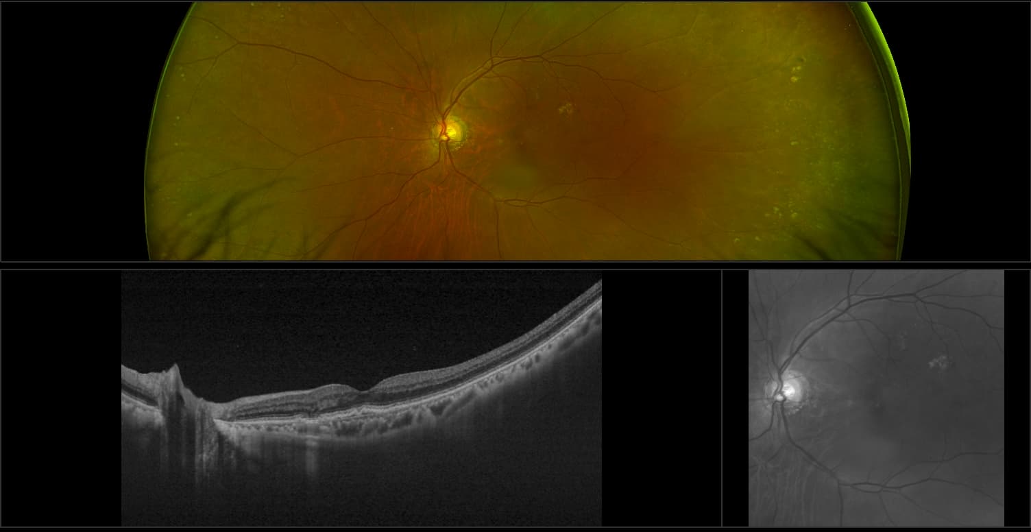 Silverstone - AMD with Geographic Atrophy, RG, OCT