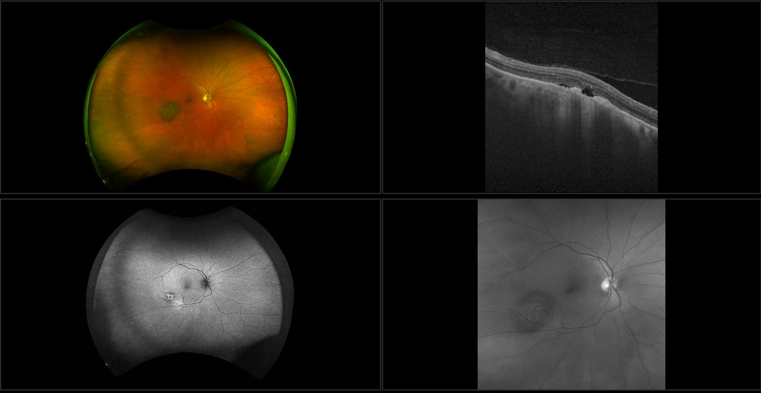 Silverstone - Nevus with Fluid, RG, AF, OCT