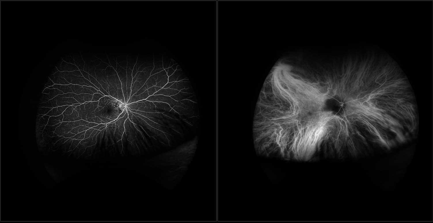 California - Juxtapapillary Choroidal Melanoma in Macula, FA, ICG