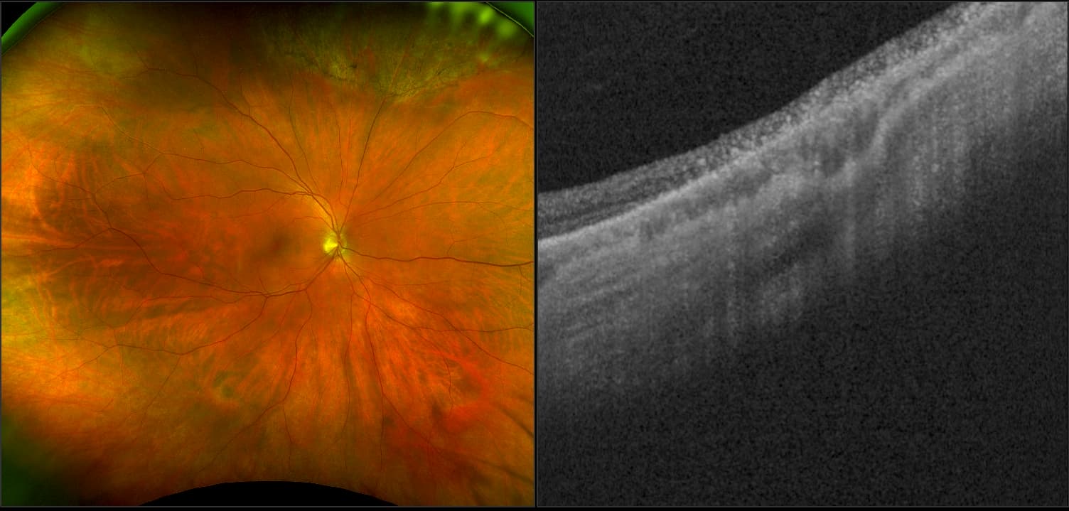 Silverstone - Peripapillary Atrophy, RG, OCT